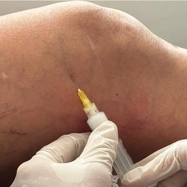 Tratamiento de escleroterapia para disminuir la apariencia de arañas vasculares y venas superficiales